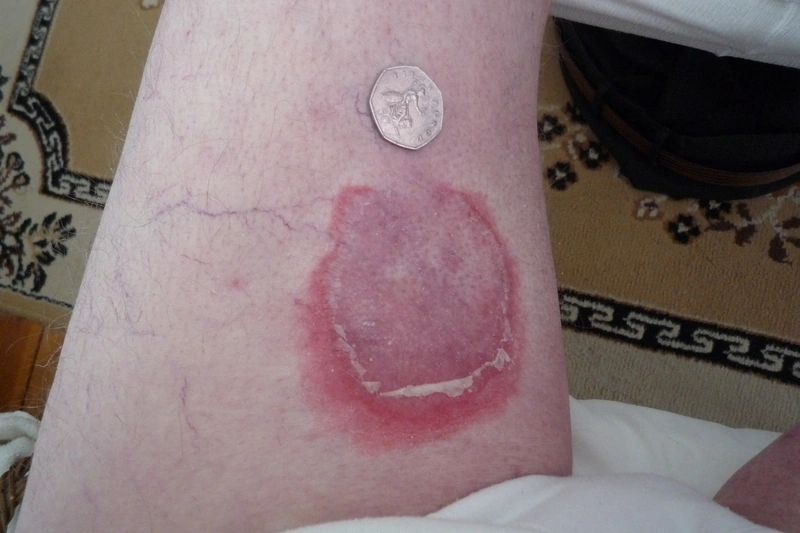 Erythema anulare centrifugum (EAC): randbetonte anuläre Plaque mit feiner Schuppenkrause am Oberschenkel (Münze zum Größenvergleich).