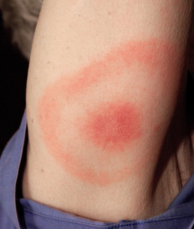 Erythema migrans (Lyme-Borreliose): zweiter Fall mit typischer Kokarde am Oberarm (Foto: James Gathany (CDC), Wikimedia Commons, Public Domain)