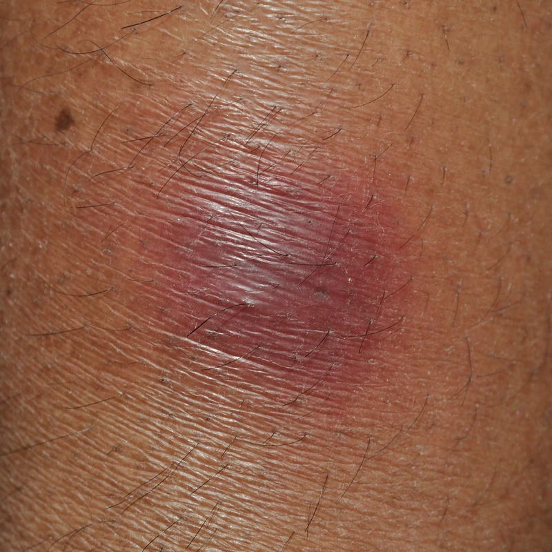 Erythema nodosum: unscharf begrenzter, druckschmerzhafter, rot-livider Knoten der Subkutis.