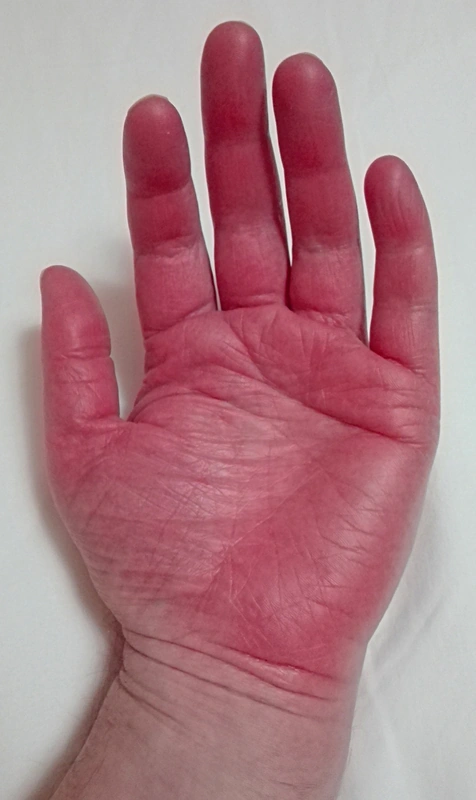 Erythromelalgie: schmerzhafte, warme, tiefrote Verfärbung der Hand bei Small-Fiber-Neuropathie. (Foto: Minor (Wikimedia Commons), Wikimedia Commons, CC BY-SA 4.0)