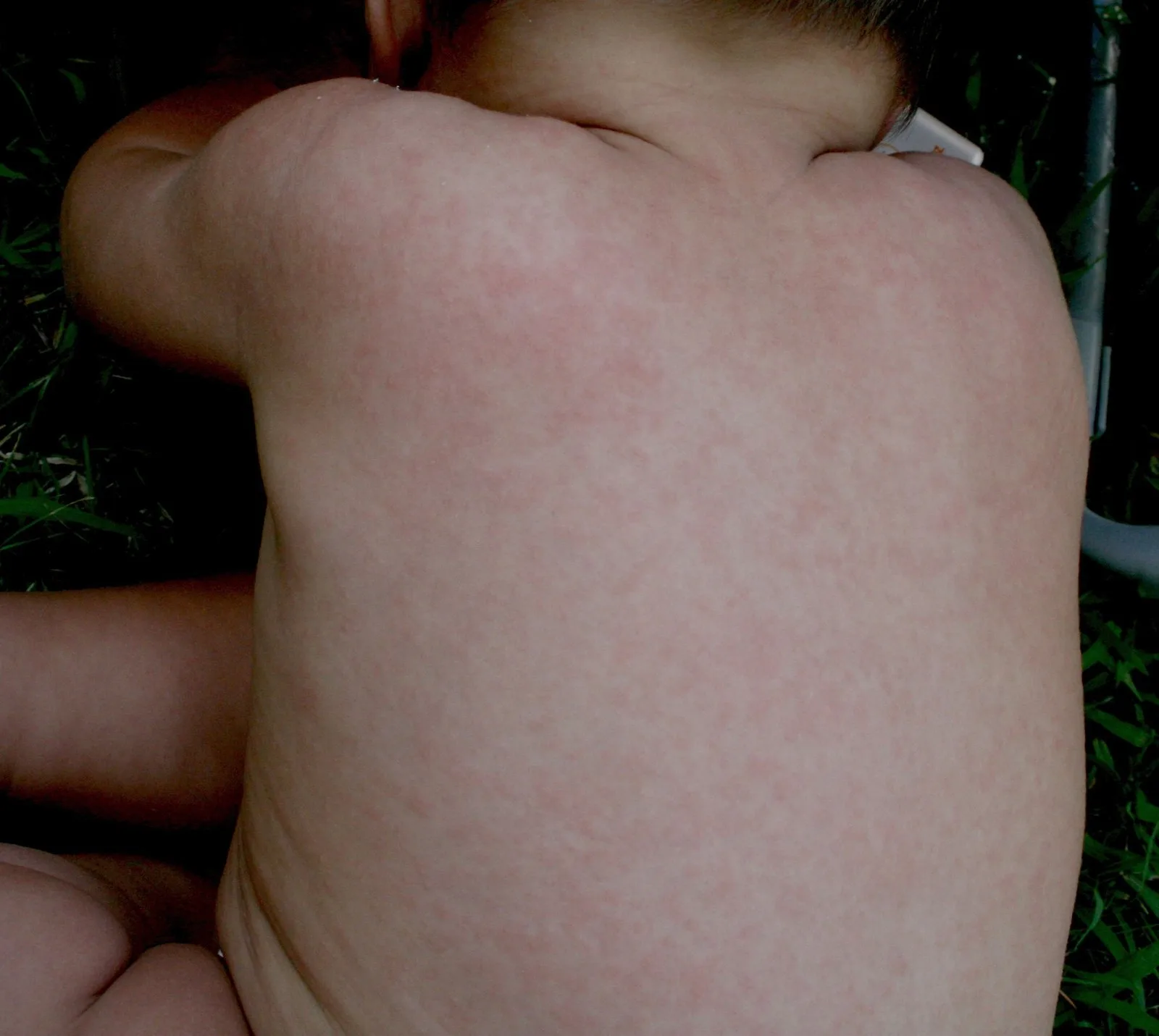 Exanthema subitum (Dreitagefieber, Roseola infantum) – klinisches Foto: feinfleckiges, blassrosa makulöses Exanthem am Rücken eines Kleinkindes
