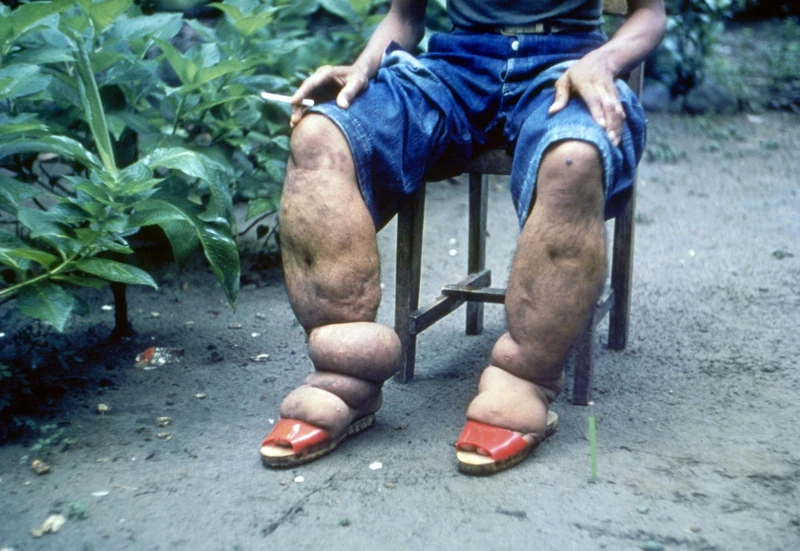 Filariasis: marked leg lymphedema (elephantiasis) with thickened, furrowed skin.