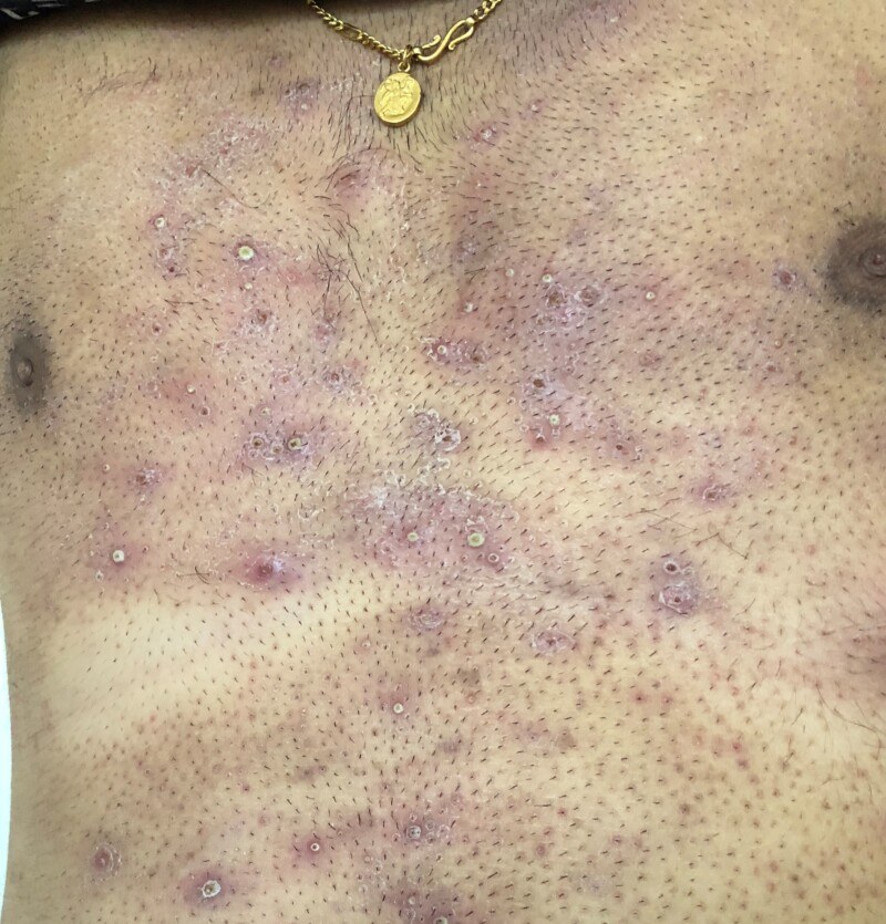 Follikulitis (infektiös): follikulär gebundene, gerötete Papeln und Pusteln nach Rasur der Brust.
