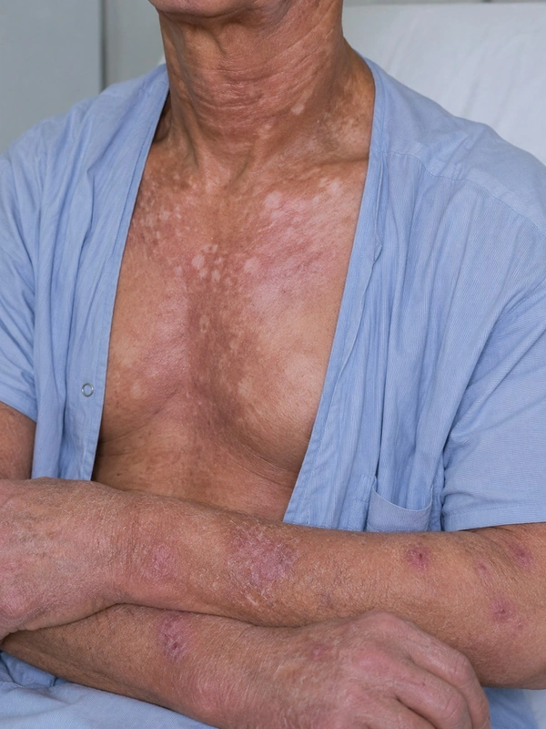 Graft-versus-Host-Disease (GvHD): lichenoide oder sklerodermiforme Hautveränderungen nach Stammzelltransplantation (60-jährige(r) Patient, Hals)