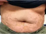 Graft-versus-Host-Disease (GvHD)