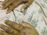 Granulomatose mit Polyangiitis (GPA) – Hautmanifestationen