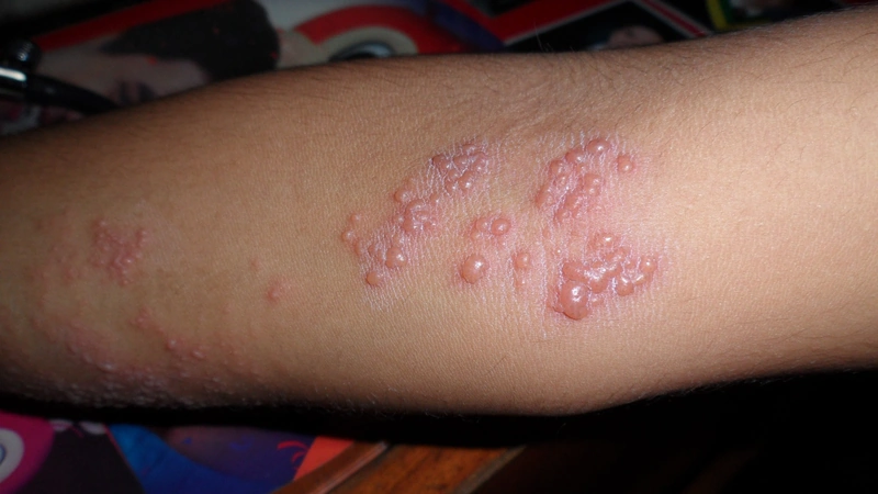 Herpes zoster: gruppierte Bläschen auf erythematösem Grund am Ellenbogen