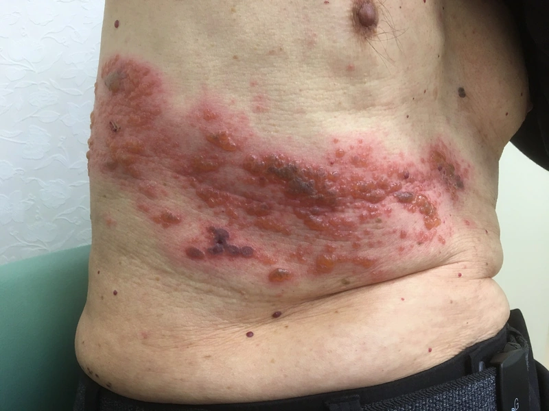 Herpes zoster: halbseitig dermatomal angeordnete Bläschengruppen an der Flanke (Tag 3) [Bild 180° gedreht 16.09.2026 — Original stand auf dem Kopf]