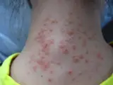 Hydroa vacciniformia