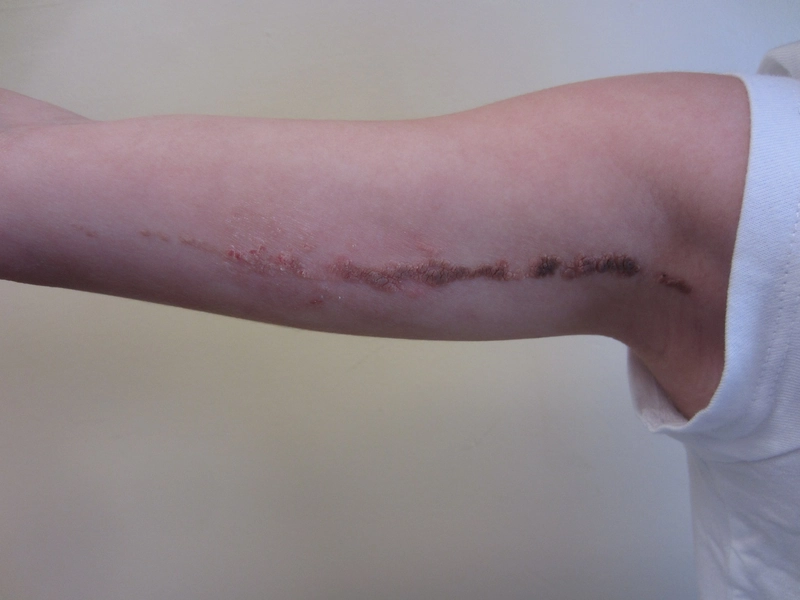 ILVEN – inflammatorischer linearer verruköser epidermaler Nävus: Verruköse, entzündlich gerötete lineare Plaque entlang der Blaschko-Linien am rechten Oberarm eines Mädchens.