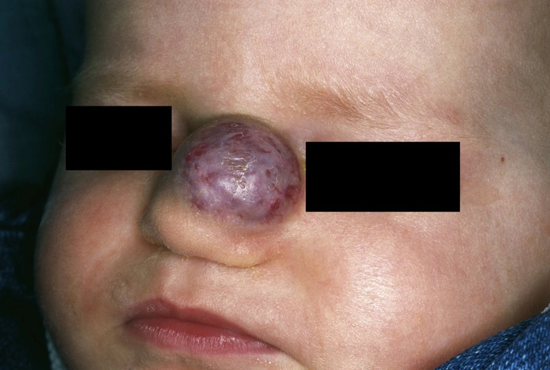 Infantiles Hämangiom: Gesicht