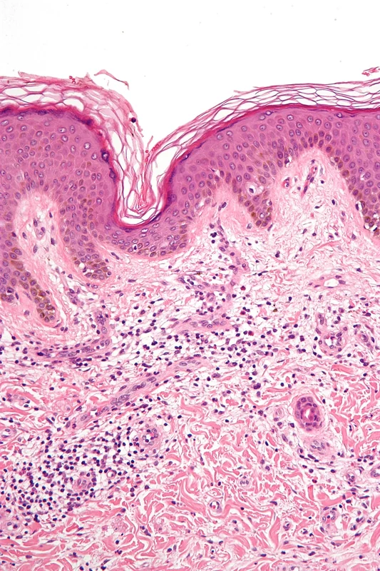 Insektenstichreaktion (lokale und gesteigerte Lokalreaktion) – Histologie (HE): weitgehend erhaltene Epidermis mit korbgeflechtartiger Hornschicht, darunter ein oberflächliches und tiefes perivaskuläres sowie interstitielles Infiltrat, das …
