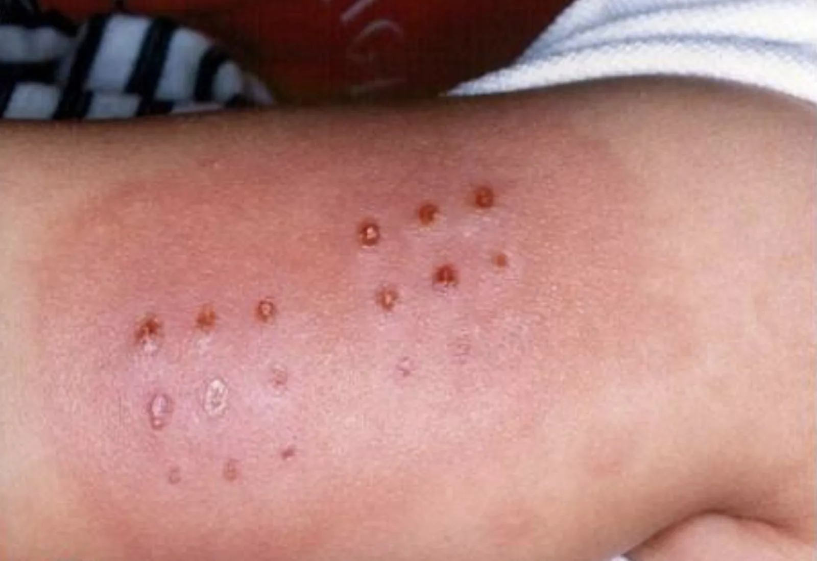 Kawasaki-Syndrom – klinisches Foto: Rötung und Verhärtung an der BCG-Inokulationsstelle am Oberarm eines Kleinkindes
