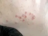 Kutane Sarkoidose