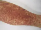 Leukozytoklastische Vaskulitis