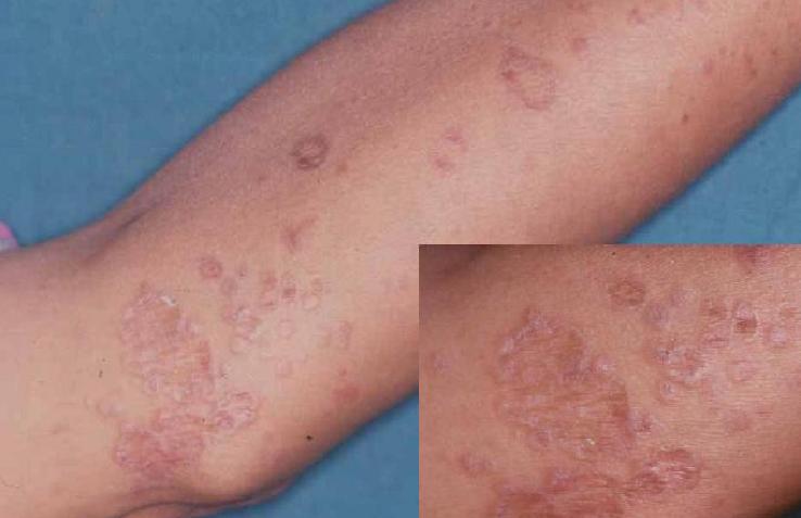 Lichen planus