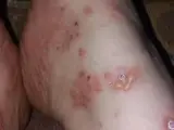 Lineare IgA-Dermatose