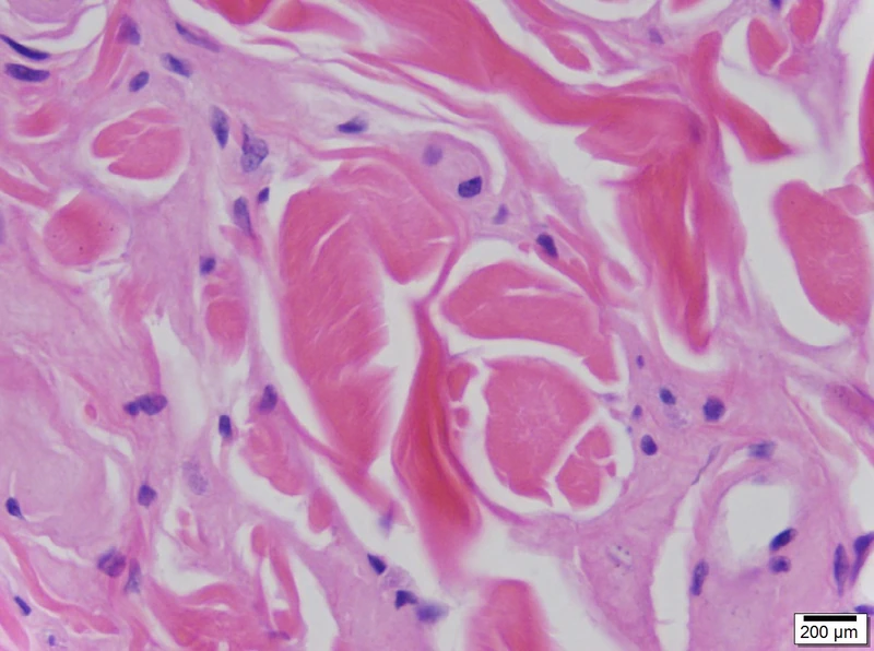 Lipoidproteinose (Urbach-Wiethe-Syndrom) – Histologie (HE): homogene, glasig-eosinophile Hyalinablagerungen in einem zellarmen dermalen Stroma mit Schrumpfungsspalten; eine zwiebelschalenartige perivaskuläre Manschettenbildung …