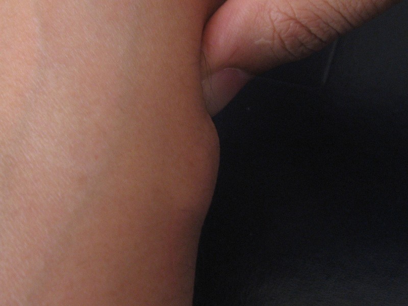Lipom – Arm – klinisches Foto: weiche, hautfarbene, glatt begrenzte subkutane Vorwölbung