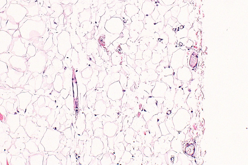 Lipom – Histologie (HE), Detailausschnitt: reife, univakuoläre Adipozyten mit randständigen Kernen, zarte fibrovaskuläre Septen, keine Lipoblasten und keine Kernatypie; Kapsel und Läsionsgrenze …