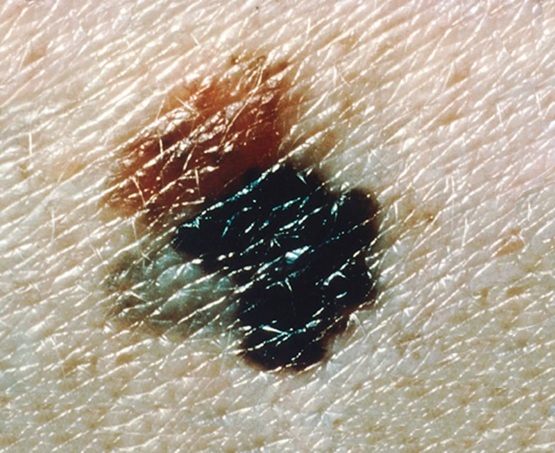 Malignes Melanom: aus einem dysplastischen Nävus (rosa-bräunlicher Anteil links) entstandenes invasives Melanom mit typischer blau-schwarzer Farbe und gekerbtem Rand (Foto: National Cancer Institute), Wikimedia Commons, Public Domain)