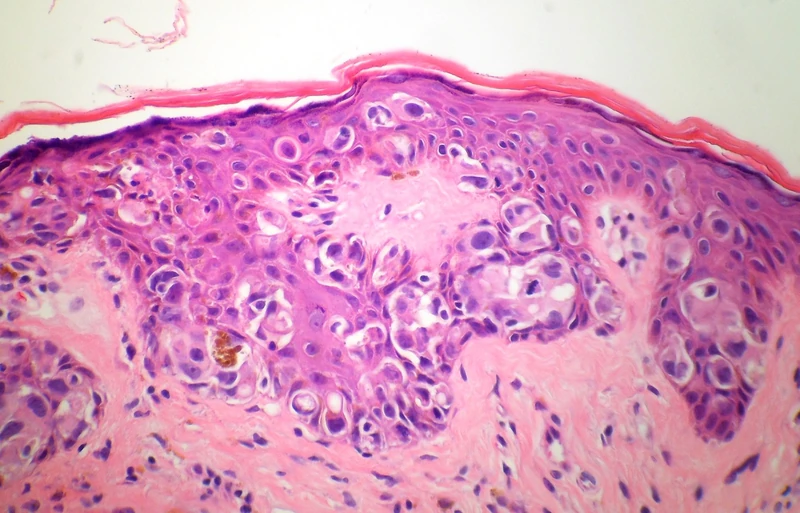Paget disease of the nipple (mammary Paget disease) – histology (H&E): large pale Paget cells with abundant cytoplasm, singly and in nests within the nipple epidermis