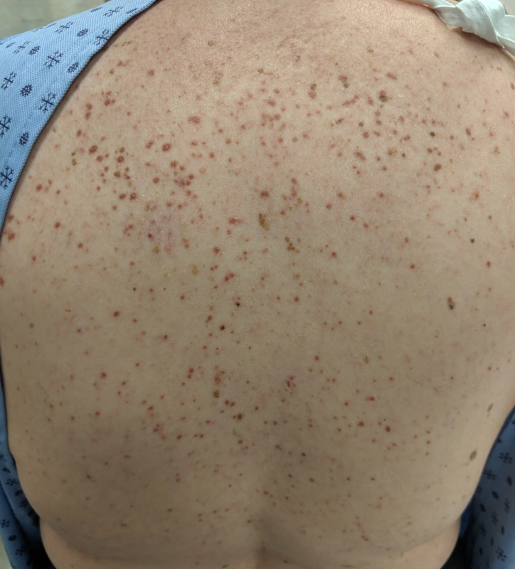 Mastozytose (Urticaria pigmentosa): zahlreiche disseminierte, rundliche bräunliche Makeln/Papeln am Rücken eines Erwachsenen (Urticaria pigmentosa)