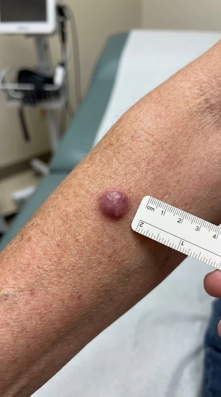 Merkelzellkarzinom: typical clinical presentation of Merkelzellkarzinom, adult patient