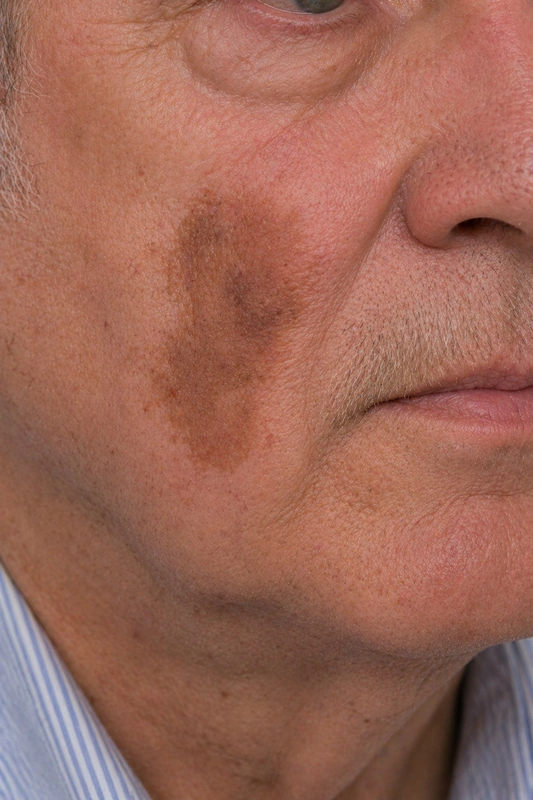 Mikrozystisches Adnexkarzinom: lokal invasiver Hauttumor zentrofazial (68-jährige(r) Patient, Wange)
