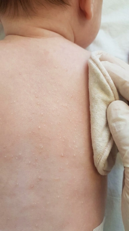 Miliaria cristallina: multiple, klare, taubropfenähnliche, oberflächliche Vesikel ohne Erythem am oberen Rücken, 6-Monate alter Säugling