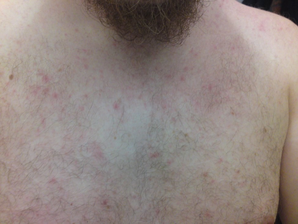 Miliaria rubra: multiple kleine erythematöse Papeln an Brust, Hals und Schulter, milde Ausprägung