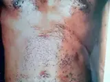 Morbus Darier