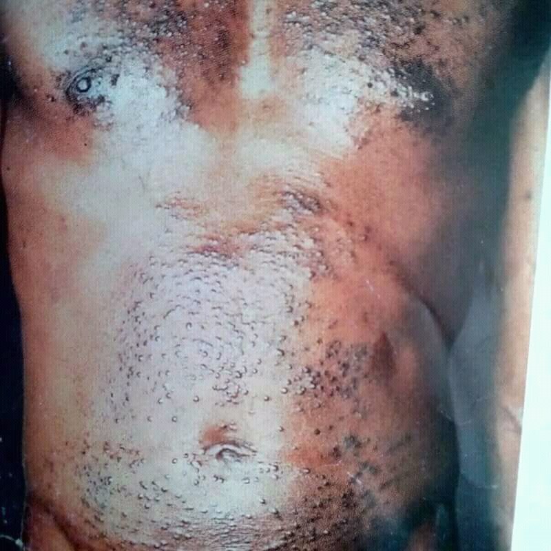 Morbus Darier: fettig-hämoglobinbraune, keratotische Papeln in den seborrhoischen Arealen der Brust.