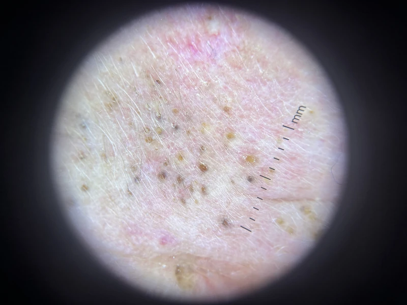 Favre-Racouchot disease: solar elastosis with multiple open comedones and cysts of the left cheek of a 71-year-old man (nodular elastosis with cysts and comedones).
