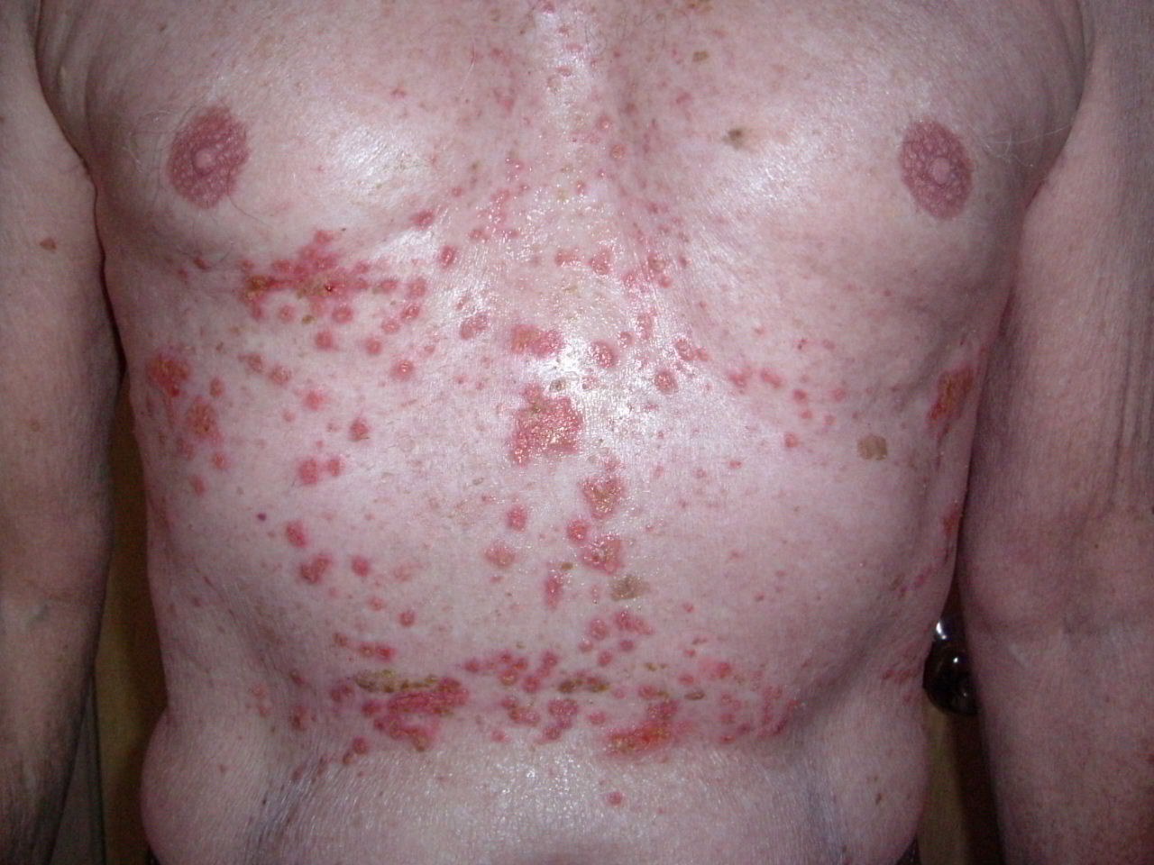 Morbus Grover (transitorische akantholytische Dermatose): multiple disseminierte erythematöse Papeln auf der Brust, fortgeschrittener Fall