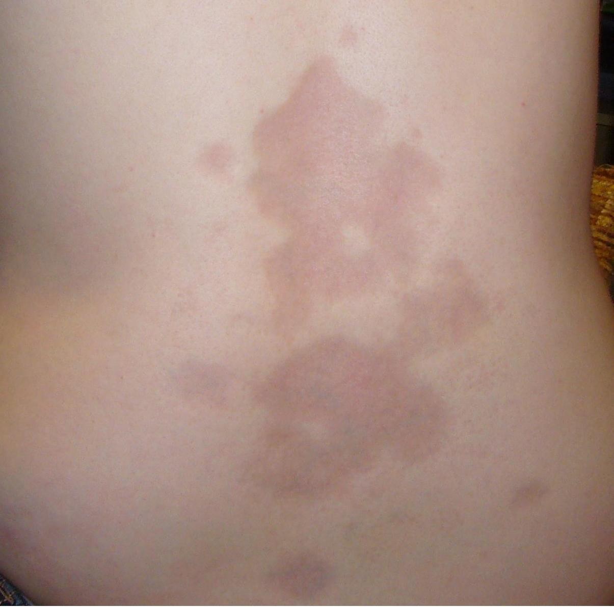 Morphea: several confluent, ill-defined brown-violaceous plaques on the back of a 16-year-old woman; the skin looks smooth and bound down without scaling: the inflammatory, pigmented early stage before ivory-coloured sclerosis (Photo: Leith C Jones)