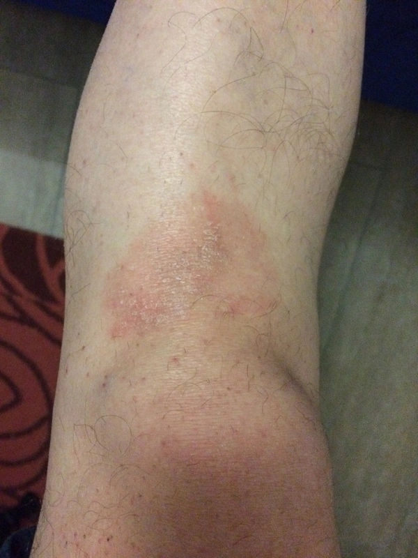 Mycosis fungoides: ill-defined, slightly infiltrated erythematosquamous lesion with fine scaling at the knee, resistant to treatment for months (Photo: Wikindrea, Wikimedia Commons, CC BY-SA 4.0)