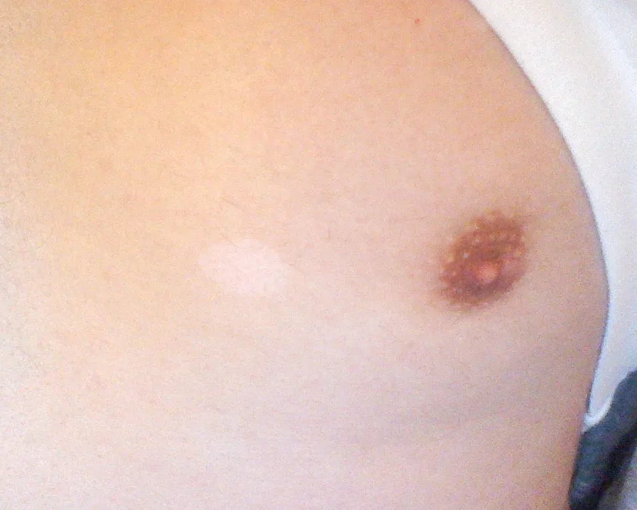 Naevus depigmentosus (achromic naevus) – breast – clinical photo: sharply demarcated off-white patch with an irregular border on the chest next to the nipple