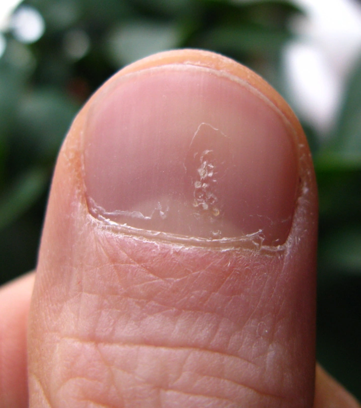 Nagelpsoriasis: charakteristisches Tüpfelnägel-Muster (multiple kleine Grübchen der Nagelplatte)