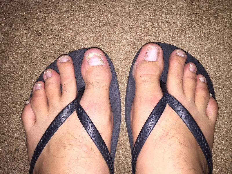 Nagelpsoriasis: Onycholyse und gelbliche Verfärbung der Zehennägel