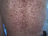 Neurofibromatose Typ 1