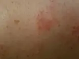 Nummular eczema (discoid eczema) – clinical photo