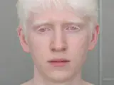 Okulokutaner Albinismus