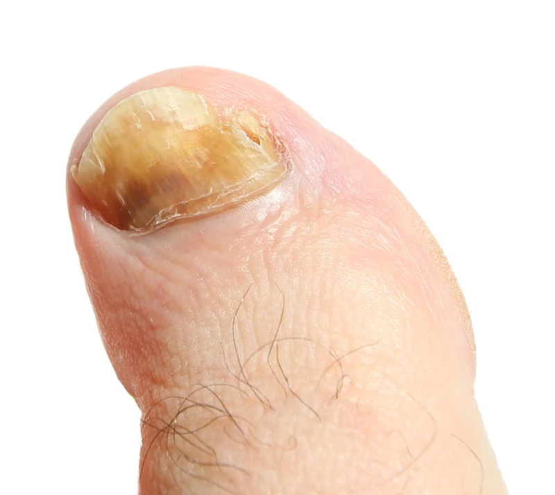 Onychomykose: gelblich verfärbte, verdickte und krümelig zerfallende Nagelplatte (distolaterale Form).