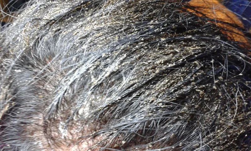 Pediculosis capitis: massenhaft Nissen, fest an den Haarschäften nahe der Kopfhaut verklebt; klinisches Bild eines Kopflausbefalls, die Eihüllen lassen sich nicht abstreifen