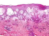 Pemphigoid gestationis