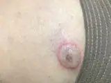 Pemphigus foliaceus
