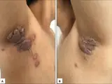 Pemphigus vegetans (Typ Neumann und Typ Hallopeau)