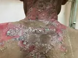 Pemphigus vulgaris