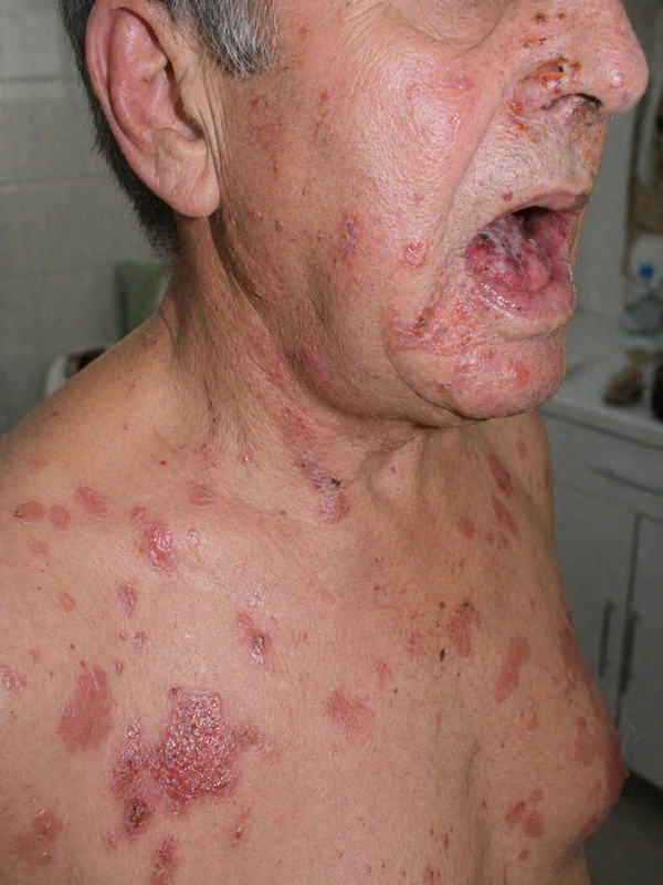 Pemphigus vulgaris: schlaffe Blasen auf normaler Haut, Nikolski I positiv, oft enorale Erosionen (Mann)